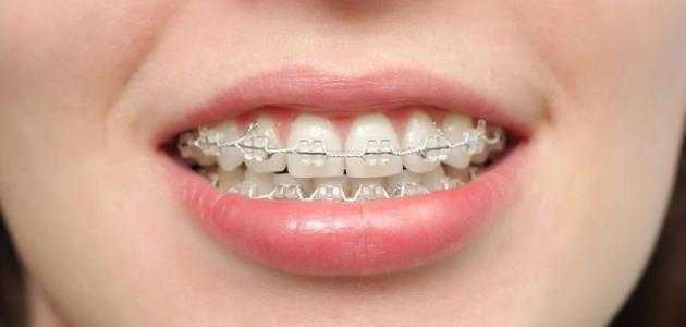 كيف_أعرف_أني_أحتاج_تقويم_أسنان.jpg
