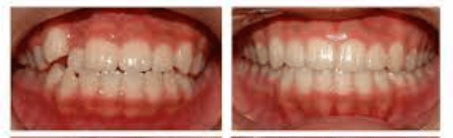 تقويم-الأسنان-قبل-وبعد-_1_-__-1.png